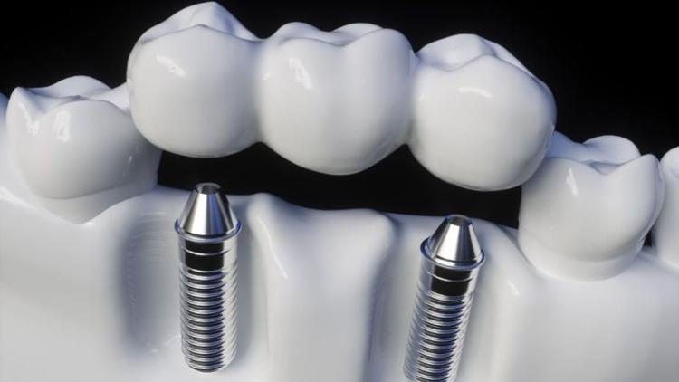 Diş implantı zor mu?