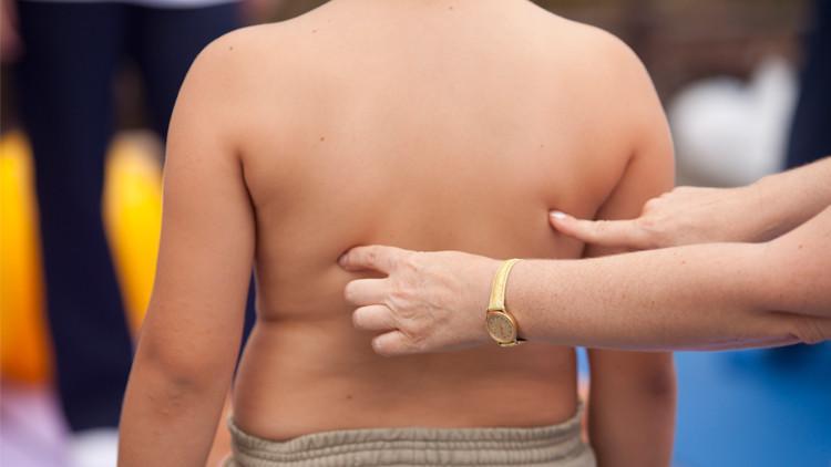 Çocuklarda obezite probleminden dolayı duruş bozukluğu da görülüyor