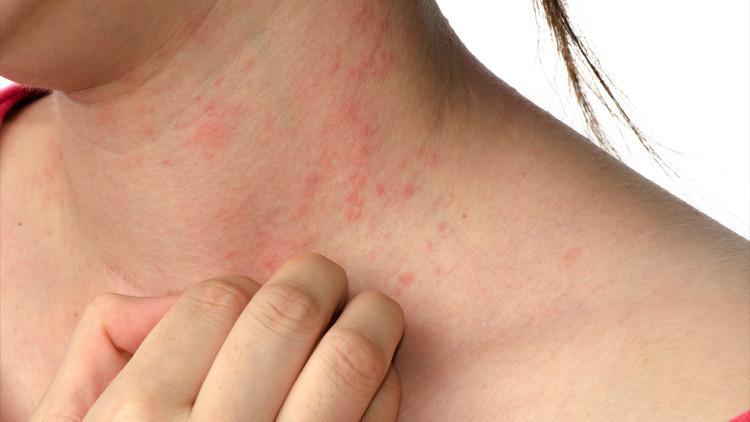 Yaz sıcaklarındaki gizli tehlike… Bağışıklığı düşük olanlar risk altında
