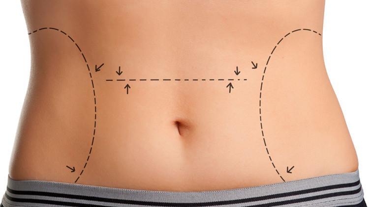 Karın germe (abdominoplasti) ameliyatı nedir?