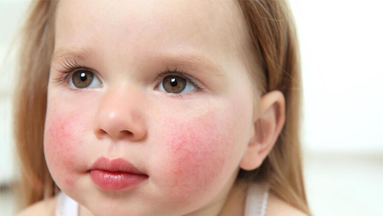 Besin alerjisi olan çocuklar için okullarda alınabilecek önlemler nelerdir