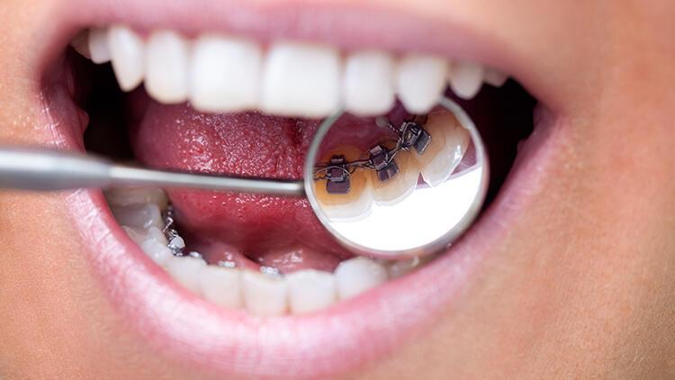 Ortodontide saklı tel tedavisi nedir?