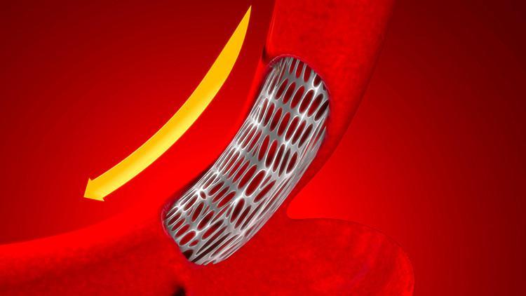 Abdominal aort anevrizması nedir? Sebepleri ve belirtileri nelerdir?
