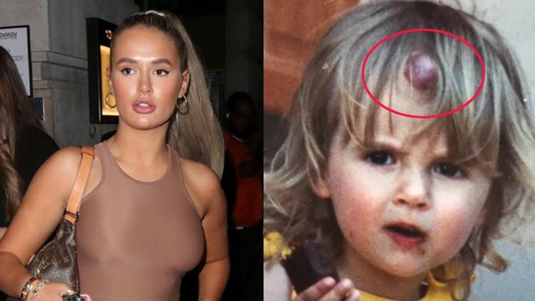 Molly- Mae Hague takipçilerini ÅŸoke etti: Alnımda böyle bir leke vardı