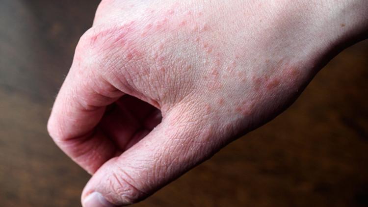 Dermatit (egzama) neden olur? Tedavisi var mıdır?