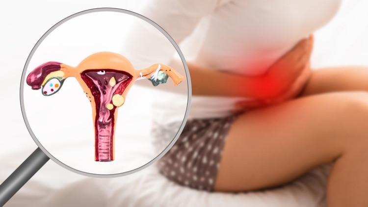 Endometriozis Hakkında Merak Edilen Her Şey