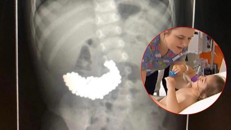 Doktorlar şoke oldu: İki yaşındaki çocuğun midesinden tam 209 tane çıktı!