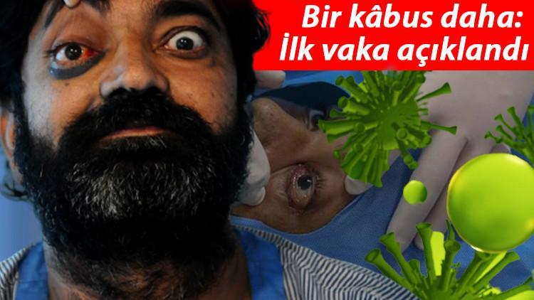 Son dakika: Bu kez de 'yeşil mantar' vakası görüldü! Hindistan'da kâbus bitmiyor...