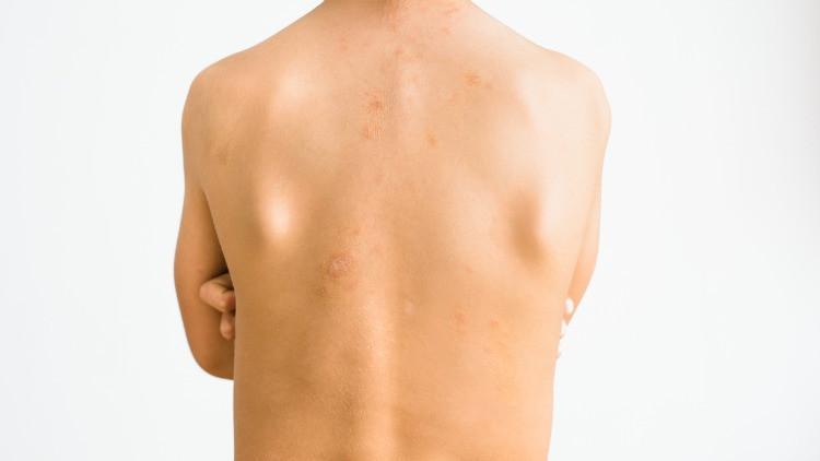 Madalyon hastalığı (Gül hastalığı) nedir, bulaşıcı mı? Madalyon hastalığı sebepleri ve belirtileri