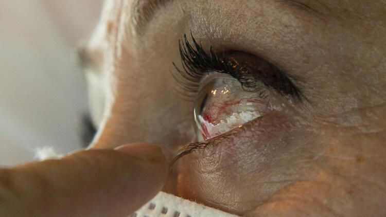 Covid-19in etkilediği bir organ daha Gözümüzü nasıl koruyabiliriz