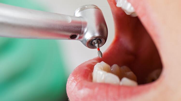 Endodonti Nedir, Neye Bakar? Endodonti Tedavisi Hakkında Bilgiler