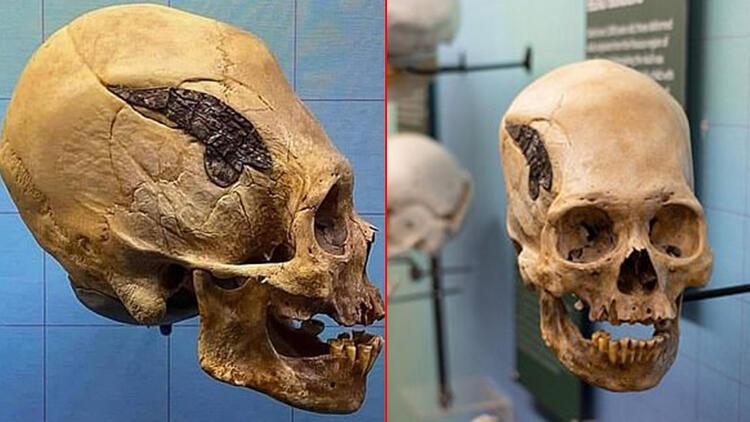 Akılalmaz keşif Dünyanın en eski kafatası ameliyatı böyle yapılmış