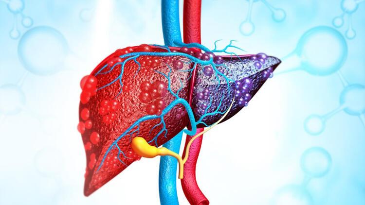 Karaciğer Yağlanması Neden Olur Ve Nasıl Geçer? Karaciğer Yağlanması Belirtileri ve Tedavisi