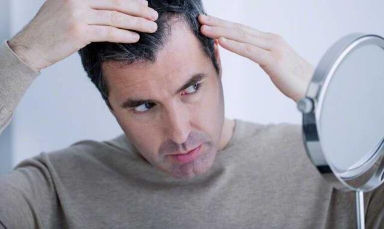Saç dökülmesi kaç tip olur? - Sağlık Haberleri