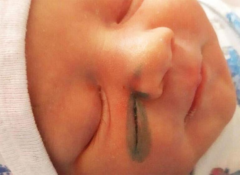 Doktorlar doğum sırasında bebeğin yüzünü kesti!