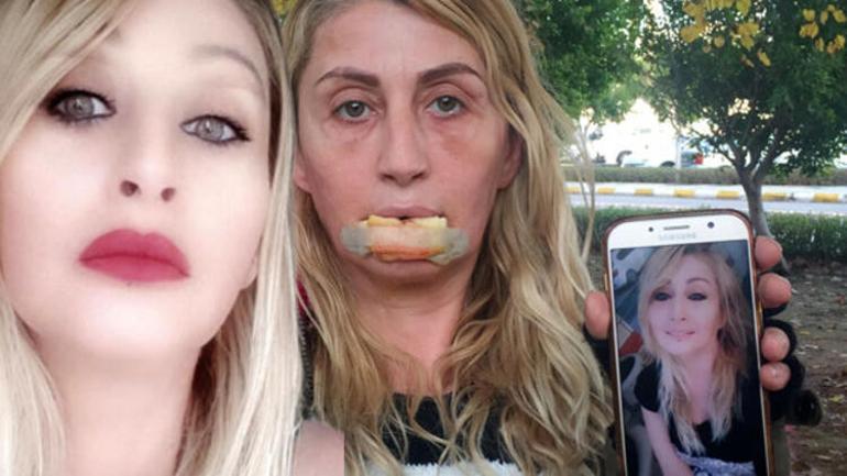 Her seferinde aynı acıyı yaşıyor Gülmeyi unuttum, mimiklerimi kaybettim