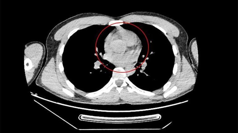 Ankara’da akılalmaz olay Midesinde patladı…