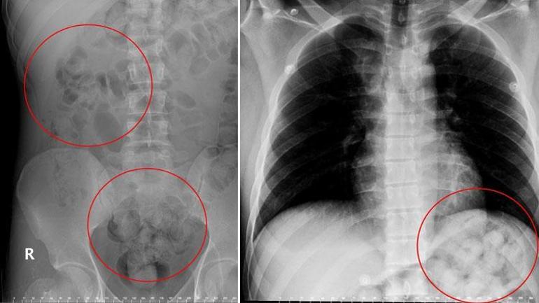 Ankara’da akılalmaz olay Midesinde patladı…