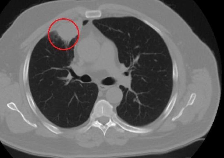 Dünya tıp literatüründe bir ilk: Covid-19, akciğer kanserini taklit etti