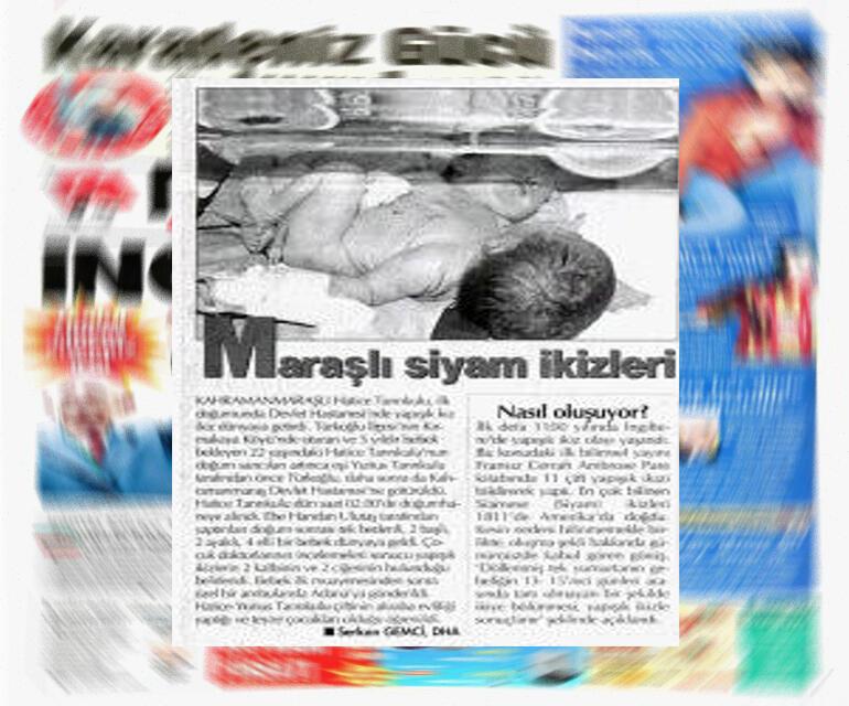 İki kafa ve üç kolla doğan bebekler şaşkına uğrattı... Merak edilenleri Türk doktor anlattı