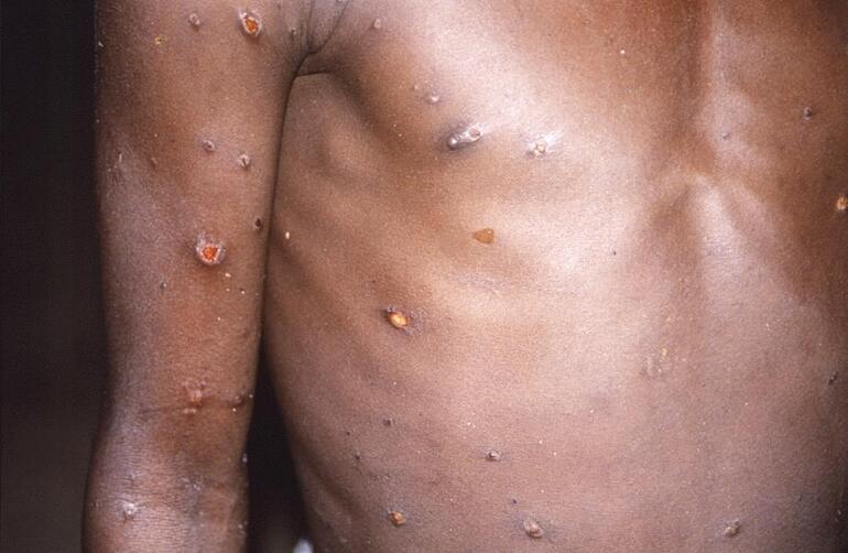 Stunning findings in the smallpox virus ... He was not expelled from the body for 76 days