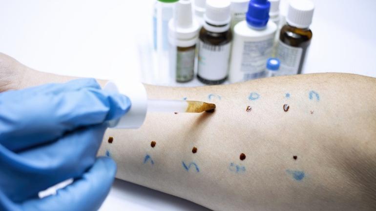 Alerjiler hep bu kadar yaygın mıydı, yoksa giderek daha mı fazla alerji oluyoruz Herkes yaşamı boyunca en az bir kez bu sorunu yaşar