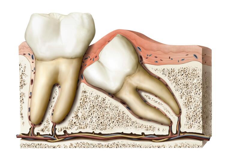 Diş hekimleri bunu tartışıyor: Yirmi yaş dişleri sorunlar başlamadan önce çektirilmeli mi | 8 SORU 8 YANIT