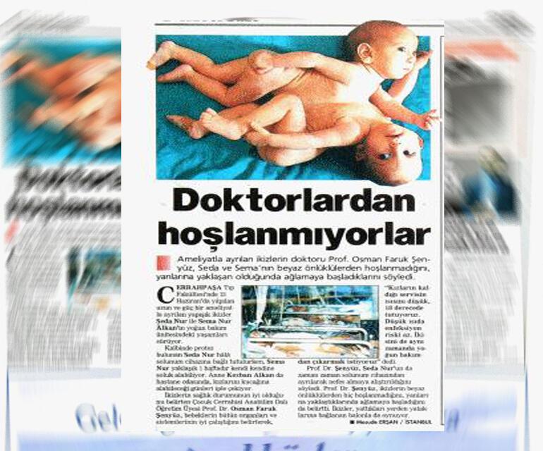İki kafa ve üç kolla doğan bebekler şaşkına uğrattı... Merak edilenleri Türk doktor anlattı
