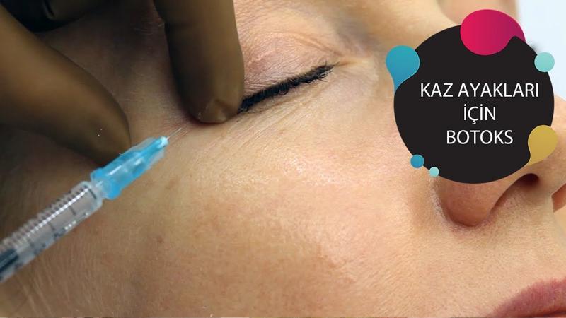 Kaz Ayağı Botoksu | Kız Kulisi