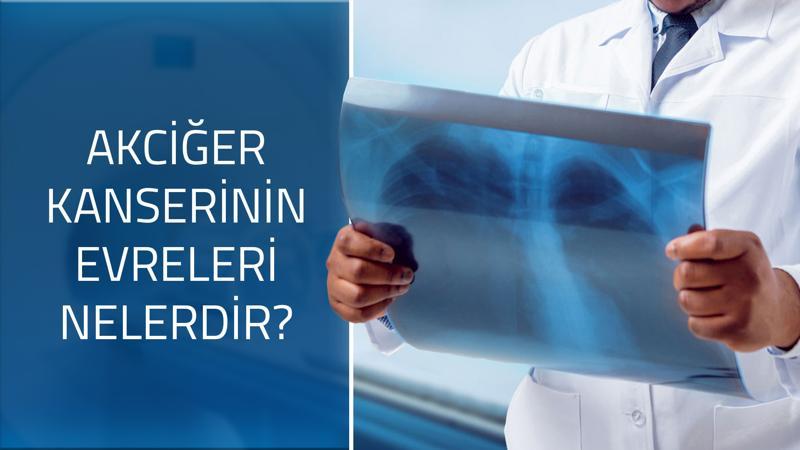 Akciğer kanserinin evreleri nelerdir?