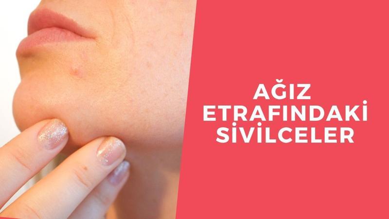 Ağız etrafı sivilceleri nasıl yok edilir?