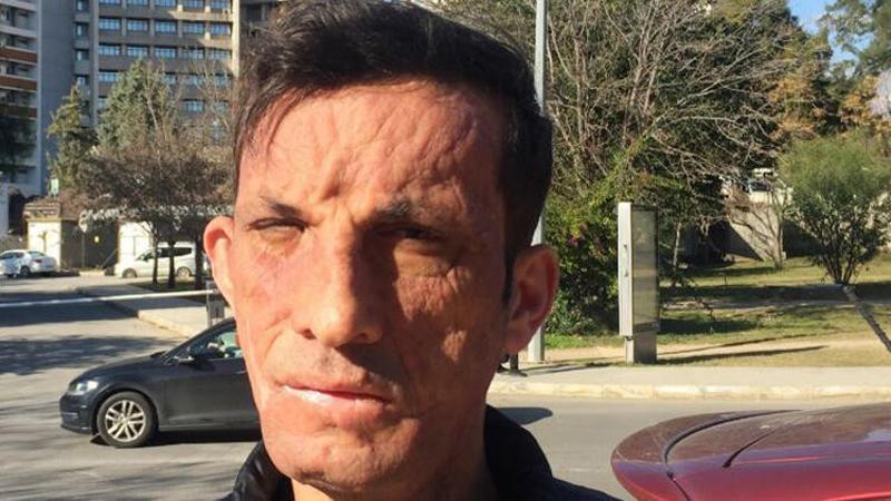 Türkiye'nin ilk yüz nakillisi Uğur Acar: Tek isteğim evlenmek