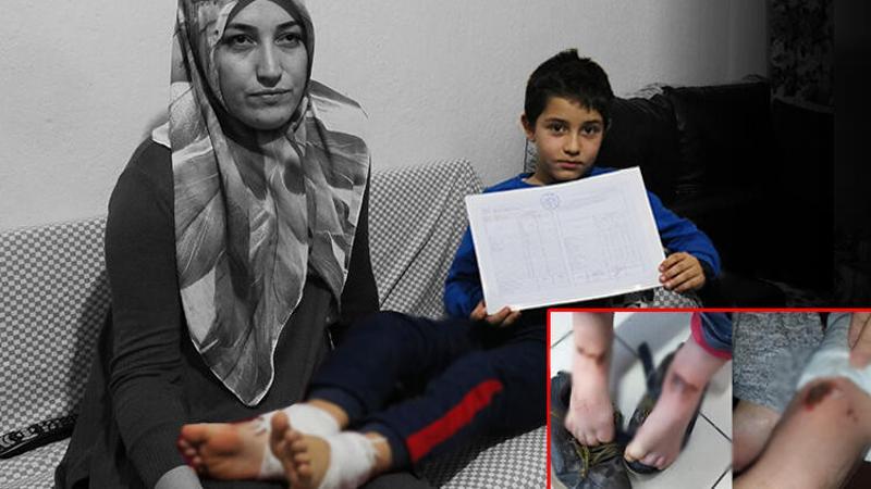 Karla oynarken vücudunda yanık oluşan Mirzah, taburcu oldu