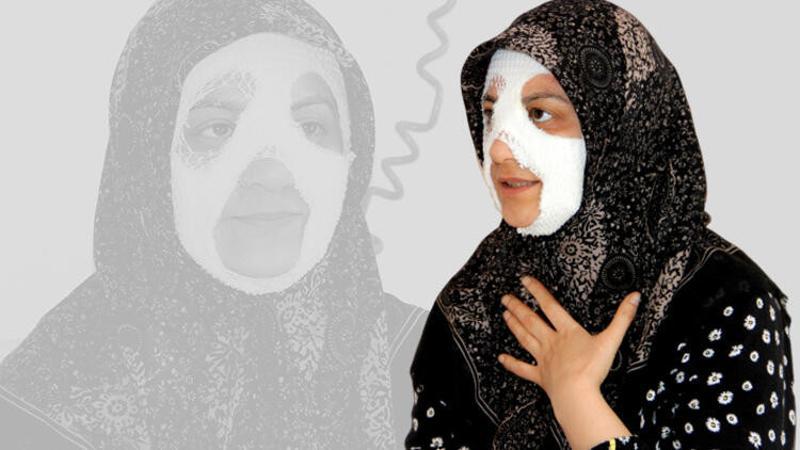 Bomba gibi patlayan düdüklü tencere genç kadına dehşeti yaşattı