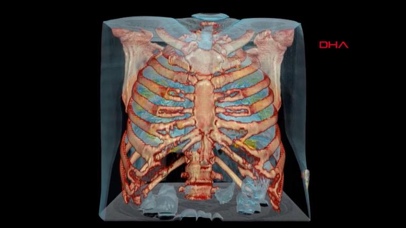 Corona virüs bulunan akciğerin 3D görüntüsü yayınlandı