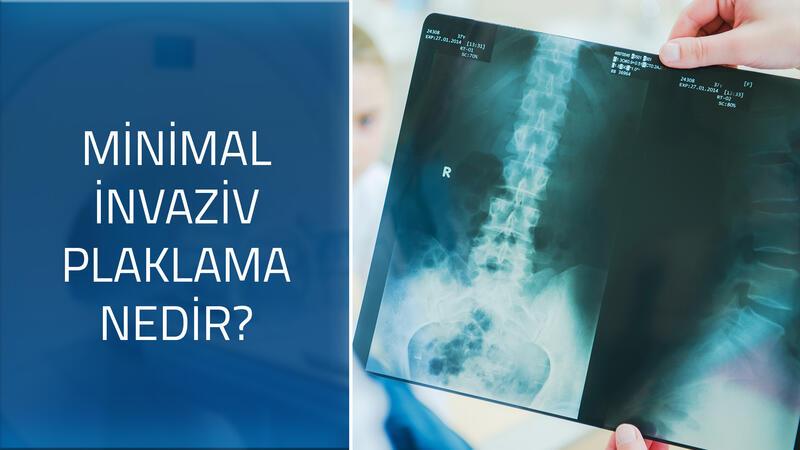  Ortopedi ve Travmatoloji Uzmanı Prof. Dr. Ufuk Özkaya cevaplıyor; Minimal invaziv plaklama nedir, nasıl yapılır, avantajları nelerdir? 