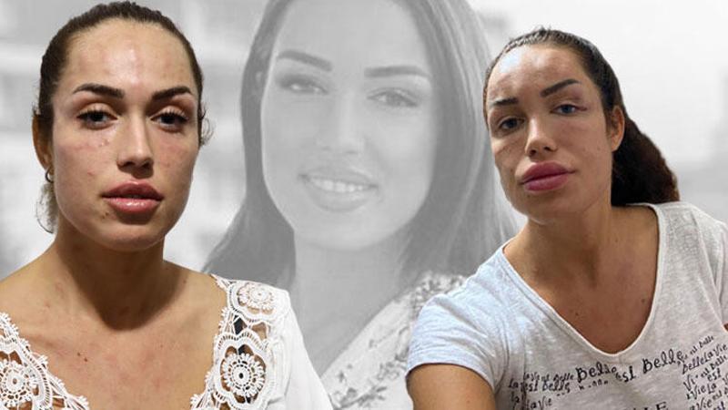 'Gençlik aşısı' nedeniyle hastanelik olduğunu iddia eden kadın: Amacım sadece yüzümü nemlendirmekti