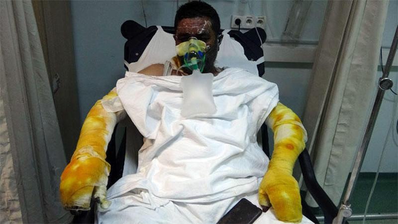 Yangında ailesini yanmaktan kurtardı, kendisi yanarak hastanelik oldu