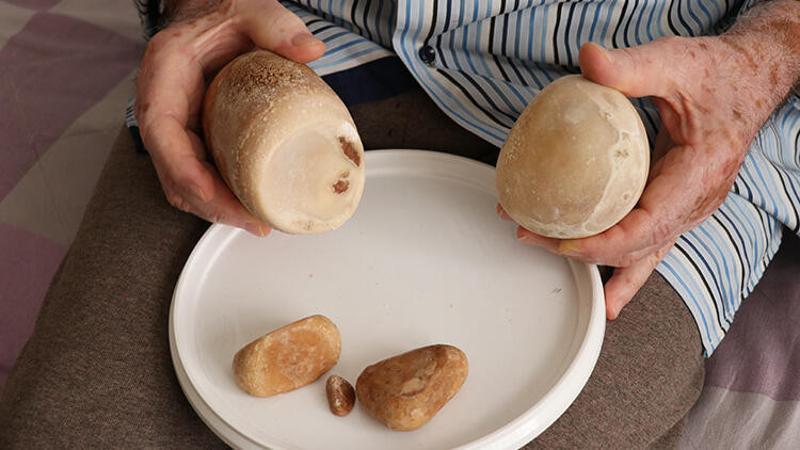 73 yaşındaki hasta mesanesinden çıkartılan 2 kilogram taşı hatıra olarak saklayacak