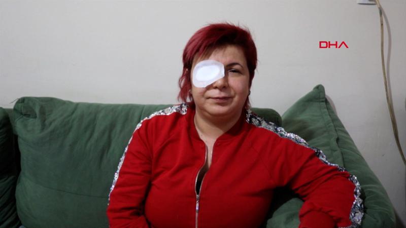 Alerji olan kadının derisi döküldü, sağ gözü görme kaybı var