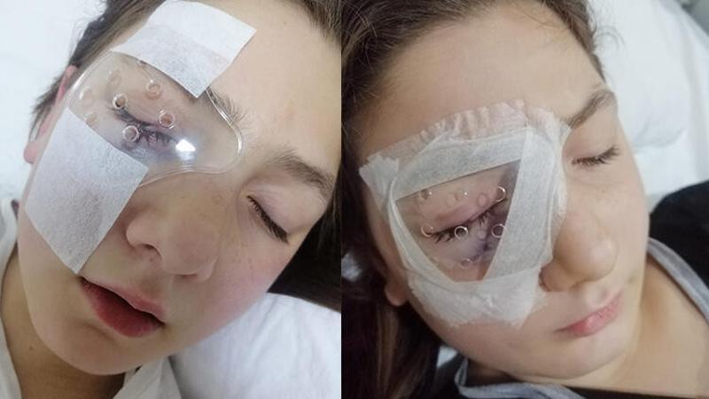 Yastık savaşı yaparken kırılan avize, 9 yaşındaki Belinay'ın gözünü yaraladı