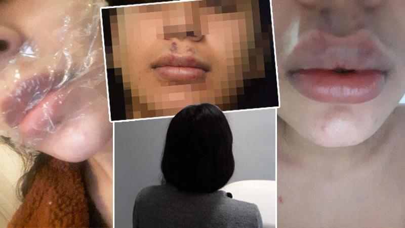 Merdiven altı yerdeki dolgu yüzünden dudağı çürüme ile karşıya kaldı