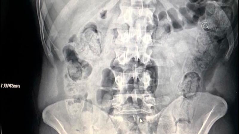 Midesinde uyuşturucu taşıyan 3 İranlı yakalandı