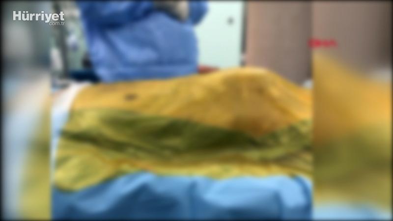Karnından 15 santimetre çapındaki dev anevrizma ameliyatla alındı