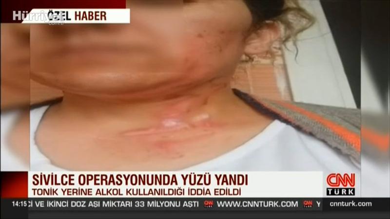 Sivilce operasyonunda yüzü yandı