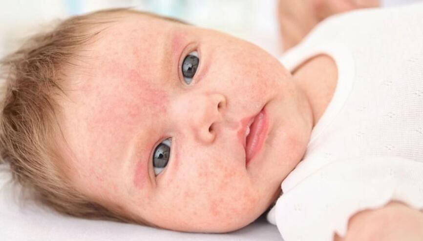 bebeklerde alerji cesitleri bebek arabasi